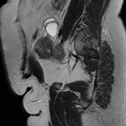 File:Adenomyosis within a didelphys uterus (Radiopaedia 70175-80215 Sagittal T2 29).jpg