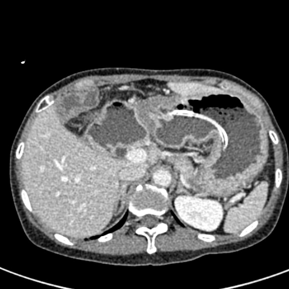 Adhesional small bowel obstruction (Radiopaedia 48397-53305 Axial C+ portal venous phase 15).jpg