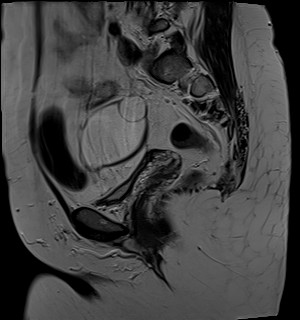 File:Adnexal multilocular cyst (O-RADS US 3- O-RADS MRI 3) (Radiopaedia 87426-103754 Sagittal T2 16).jpg