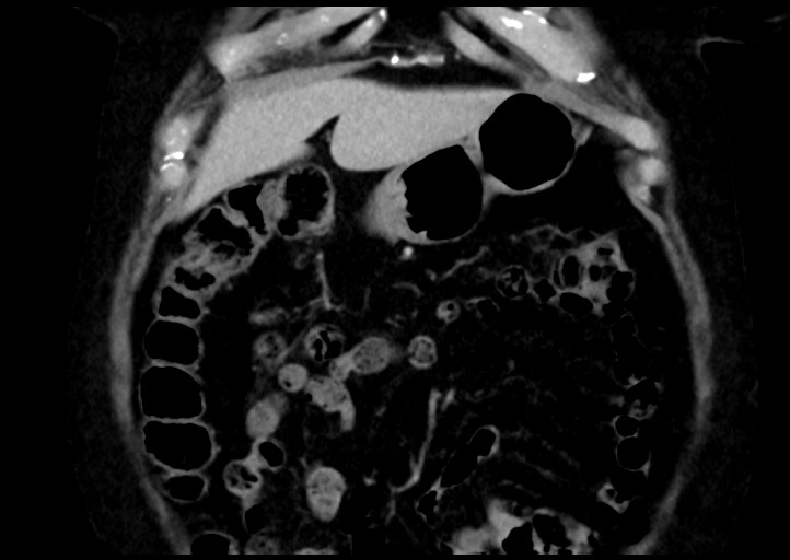 Adrenal cortical carcinoma (Radiopaedia 64017-72769 Coronal C+ portal venous phase 11).jpg