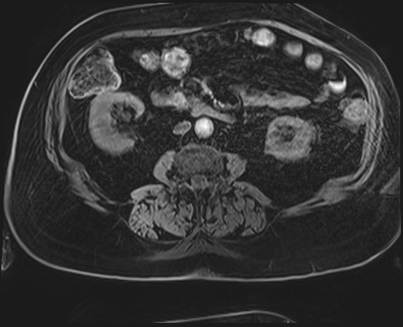Adrenal cortical carcinoma (Radiopaedia 64017-72770 H 34).jpg