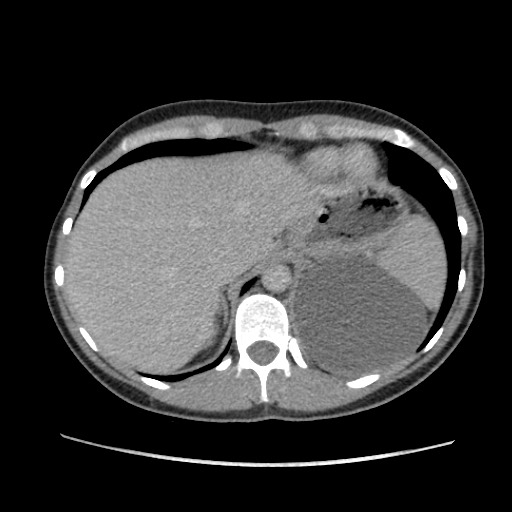 Adrenal cyst (Radiopaedia 64869-73813 Axial C+ portal venous phase 16).jpg