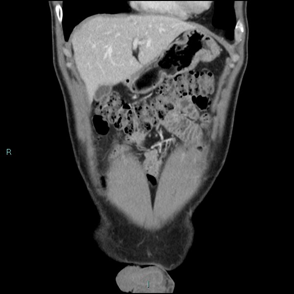 File:Adrenal cystic lymphangioma (Radiopaedia 83161-97534 Coronal C+ portal venous phase 18).jpg