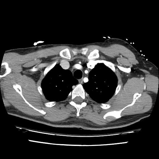 Adrenal gland trauma (Radiopaedia 81351-95078 Axial Dual bolus trauma C+ 18).jpg