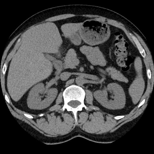 Adrenal gland trauma (Radiopaedia 81351-95079 Axial non-contrast 39).jpg