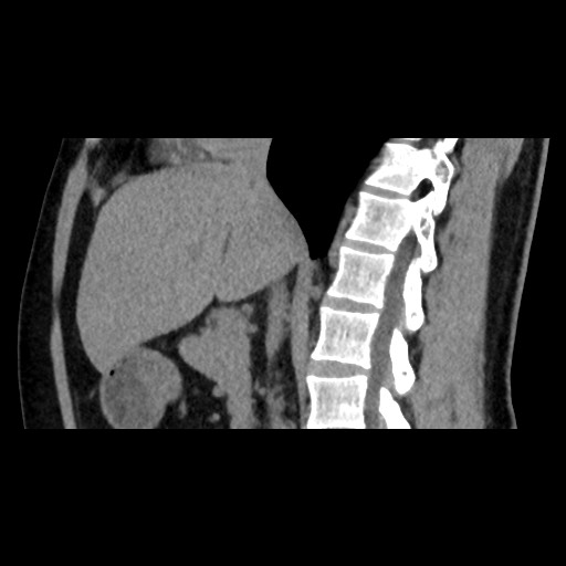 Adrenal gland trauma (Radiopaedia 81351-95079 Sagittal non-contrast 47).jpg