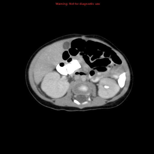 File:Adrenal hemorrhage (Radiopaedia 9390-10077 Axial C+ portal venous phase 16).jpg