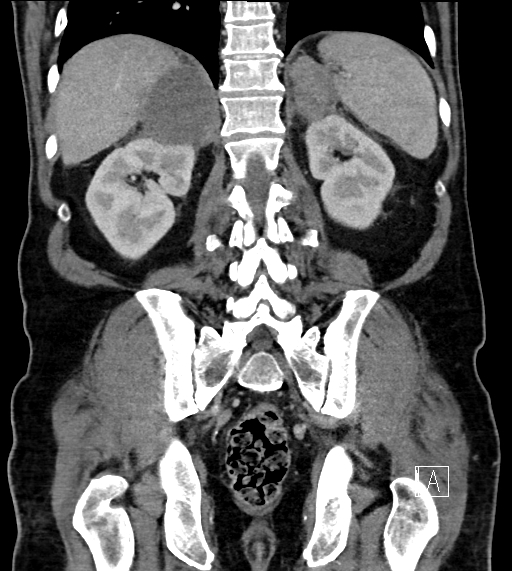 Adrenal lymphoma (Radiopaedia 73730-84529 Coronal C+ portal venous phase 59).jpg