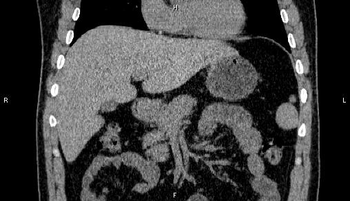 Adrenal myelolipoma (Radiopaedia 84321-99619 Coronal non-contrast 29).jpg