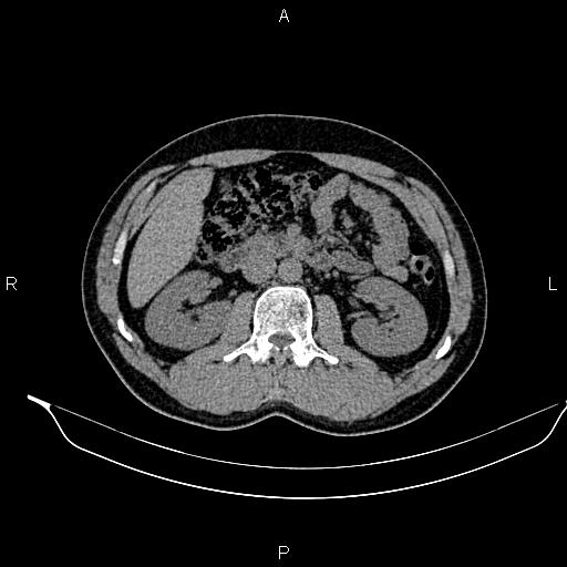 Adrenal myelolipoma (Radiopaedia 87794-104246 Axial non-contrast 46).jpg