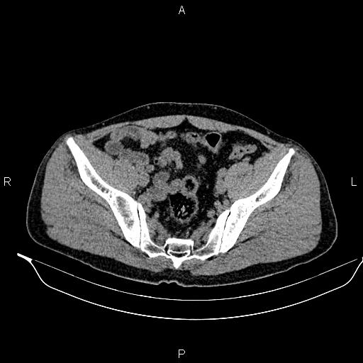 Adrenal myelolipoma (Radiopaedia 87794-104246 Axial non-contrast 87).jpg