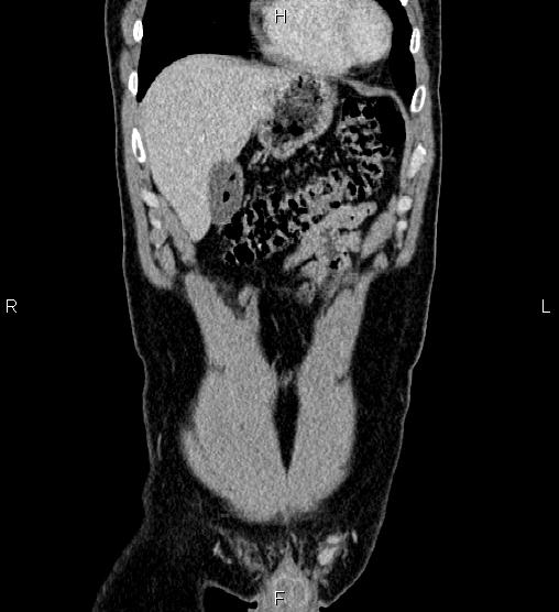 Adrenal myelolipoma (Radiopaedia 87794-104246 Coronal renal cortical phase 10).jpg