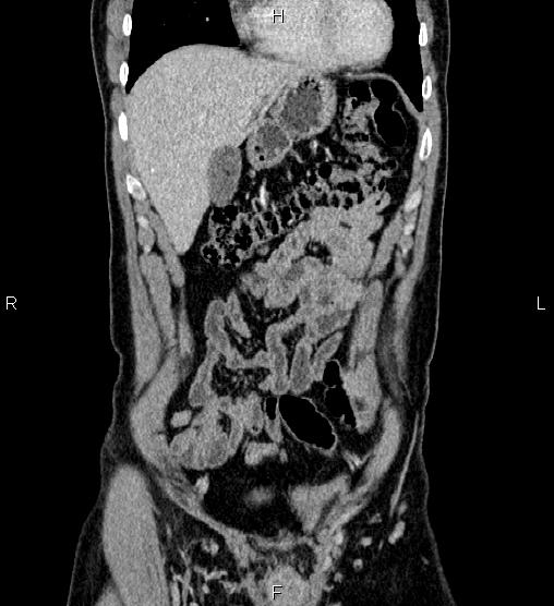 Adrenal myelolipoma (Radiopaedia 87794-104246 Coronal renal cortical phase 14).jpg