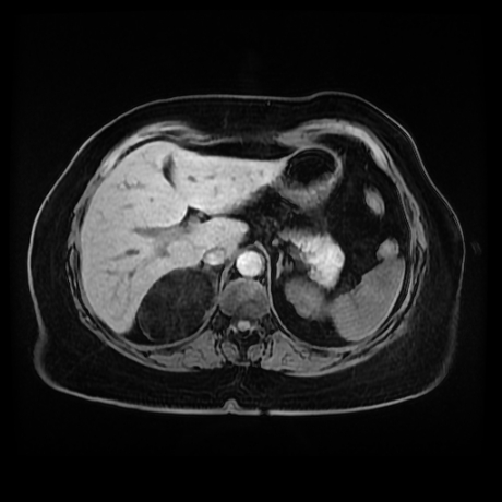 Adrenal myelolipoma - MRI (Radiopaedia 83249-97646 Axial T1 fat sat 22).jpg
