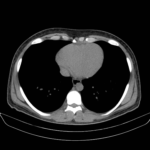 Adrenal myelolipoma - bilateral (Radiopaedia 74805-85810 Axial non-contrast 3).jpg