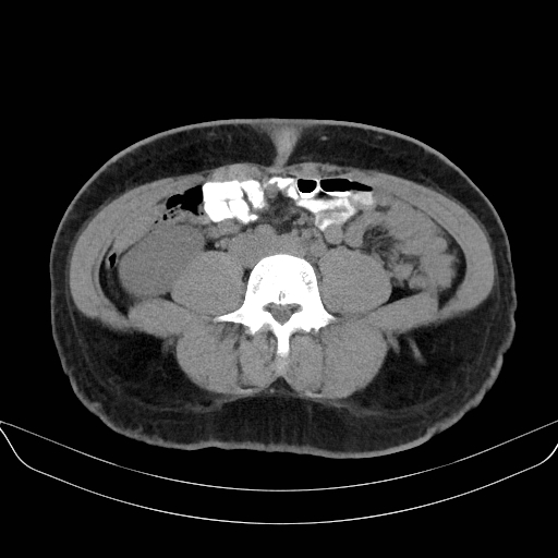 File:Adrenal myelolipoma - bilateral (Radiopaedia 74805-85810 Axial non-contrast 48).jpg