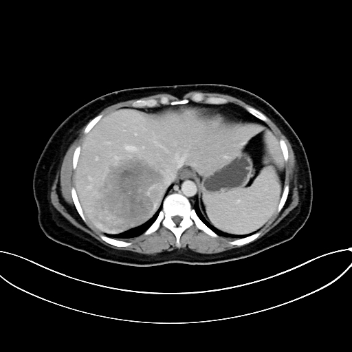 Adrenocortical carcinoma (Radiopaedia 87281-103569 Axial C+ portal venous phase 16).jpg