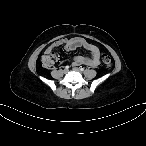 Adrenocortical carcinoma (Radiopaedia 87281-103569 Axial C+ portal venous phase 58).jpg