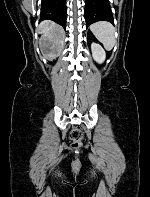 Adrenocortical carcinoma (Radiopaedia 87281-103569 Coronal C+ portal venous phase 122).jpg