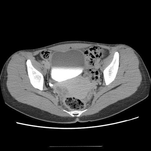 File:Adult polycystic kidney disease (Radiopaedia 48845-53876 Axial renal excretory phase 84).jpg