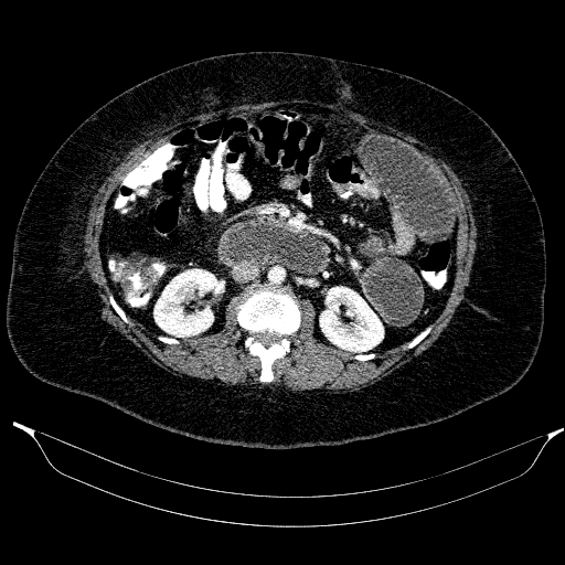 Afferent loop syndrome - secondary to incarcerated trocar site hernia (Radiopaedia 82959-97305 Axial C+ portal venous phase 105).jpg