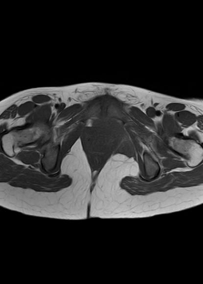 File:Aggressive angiomyxoma of the pelvis and perineum (Radiopaedia 59162-66479 T1 7).jpg