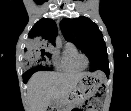 Air bronchogram in pneumonia (Radiopaedia 85719-101512 Coronal non-contrast 14).jpg