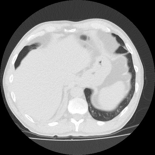 File:Allergic bronchopulmonary aspergillosis (ABPA) (Radiopaedia 60594-68313 Axial lung window 49).jpg