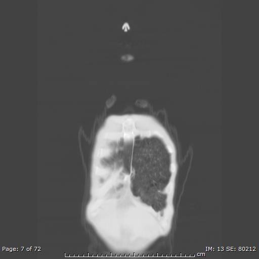 File:Alpha-1-antitrypsin deficiency (Radiopaedia 50561-55987 Coronal lung window 5).jpg