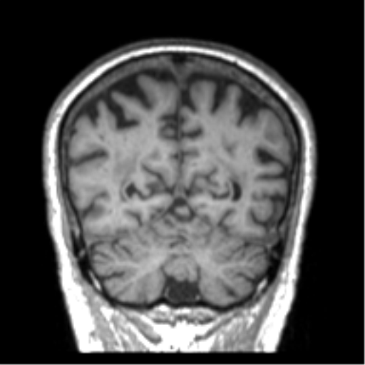 Alzheimer disease and cerebral amyloid angiopathy (Radiopaedia 64234-73011 Coronal T1 9).png