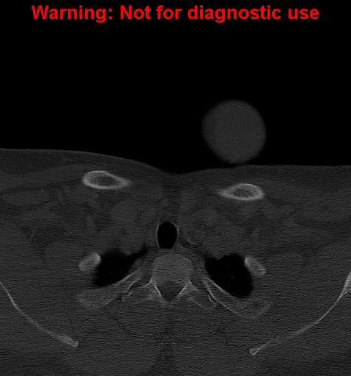 Ameloblastoma (Radiopaedia 33126-34164 Axial bone window 48).jpg