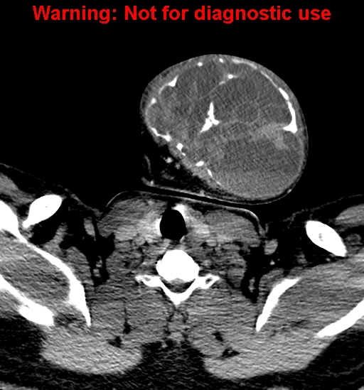 File:Ameloblastoma (Radiopaedia 33126-34164 B 31).jpg