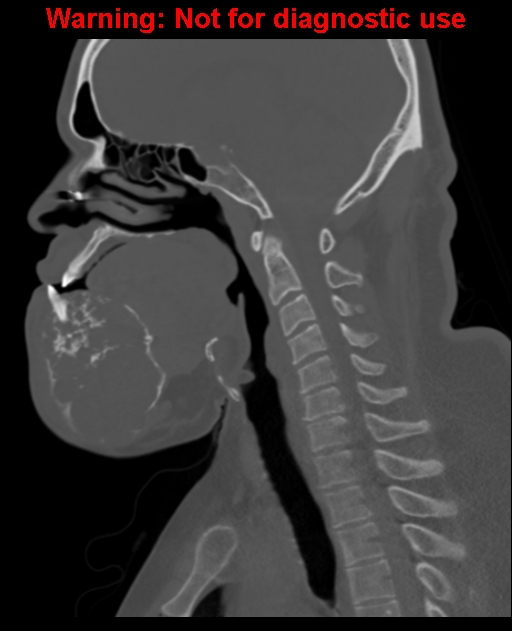 Ameloblastoma (Radiopaedia 33126-34164 Sagittal bone window 42).jpg