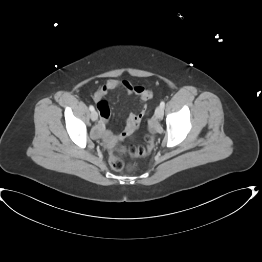File:Amoebic liver abscess (Radiopaedia 52611-58530 A 86).png
