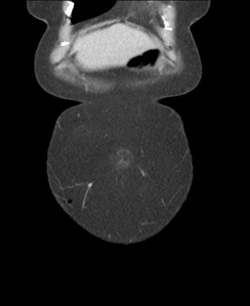 Ampullary adenocarcinoma (Radiopaedia 34013-35237 E 8).png