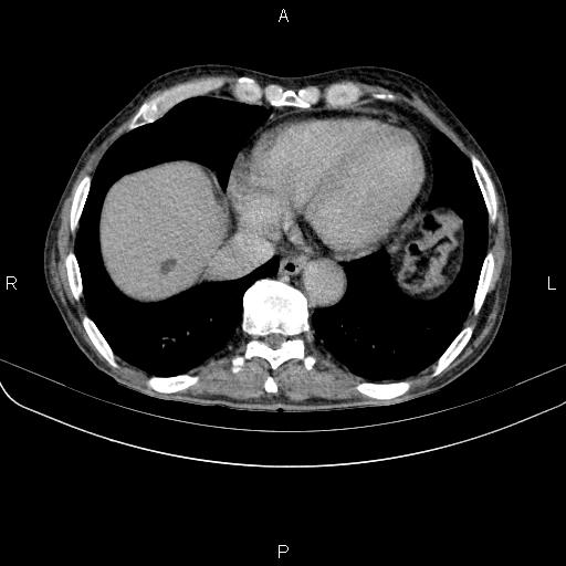 Ampullary adenocarcinoma (Radiopaedia 86093-102033 Axial C+ delayed 9).jpg
