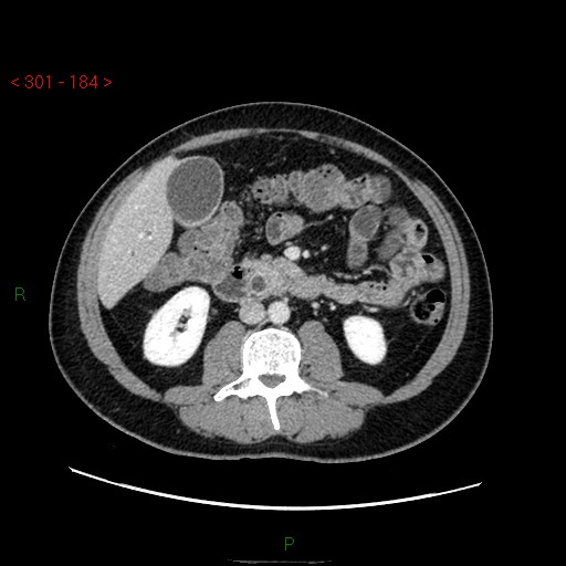 Ampullary carcinoma (Radiopaedia 56396-63056 C 50).jpg