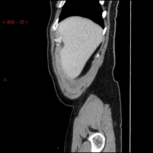 Ampullary carcinoma (Radiopaedia 56396-63056 D 14).jpg