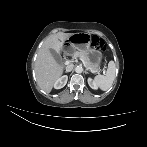 Ampullary tumor (Radiopaedia 60333-67998 A 20).jpg