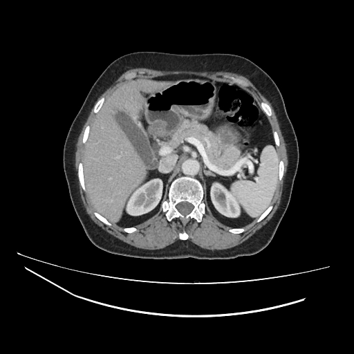 Ampullary tumor (Radiopaedia 60333-67998 A 21).jpg