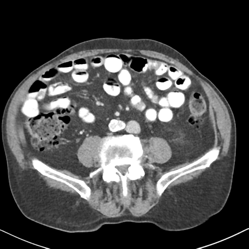 File:Amyand hernia (Radiopaedia 39300-41547 A 42).png