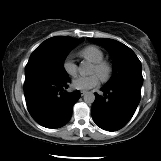 File:Amyloidosis - bronchial and diffuse nodular pulmonary involvement (Radiopaedia 60156-67744 Axial non-contrast 34).jpg