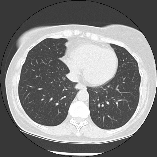 Amyloidosis - bronchial and diffuse nodular pulmonary involvement (Radiopaedia 60156-67744 B 41).jpg