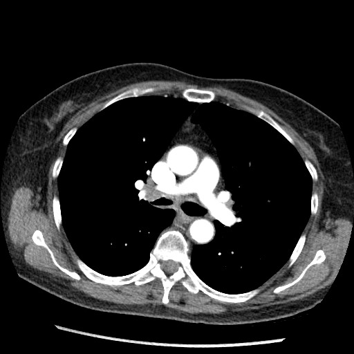 File:Amyloidosis - bronchial and diffuse nodular pulmonary involvement (Radiopaedia 60156-67745 A 22).jpg