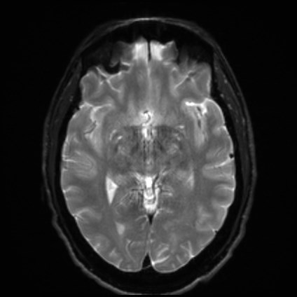 File:Amyotrophic lateral sclerosis (Radiopaedia 87352-103658 Axial DWI 12).jpg