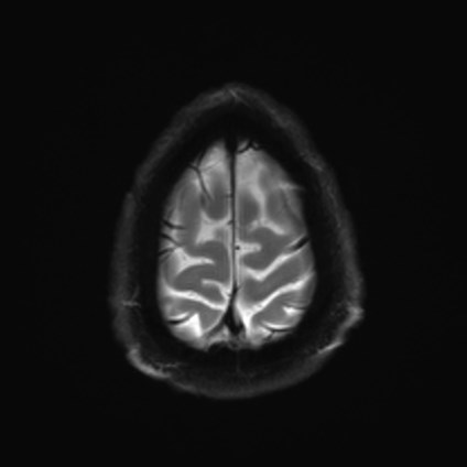 File:Amyotrophic lateral sclerosis (Radiopaedia 87352-103658 Axial DWI 26).jpg