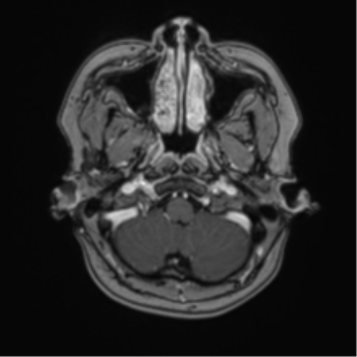 Anaplastic astroblastoma (Radiopaedia 55666-62194 Axial T1 C+ 10).png