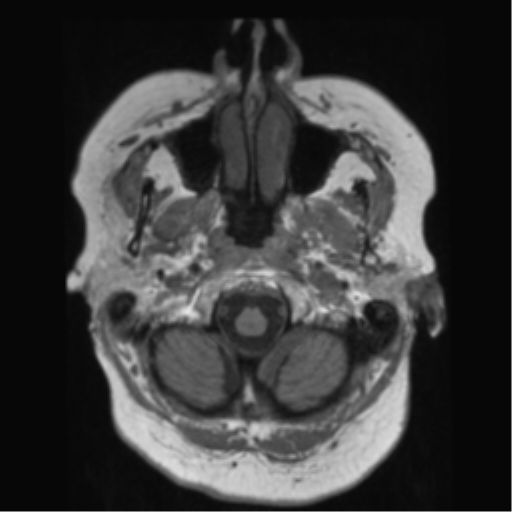 File:Anaplastic astrocytoma IDH wild-type (pseudoprogression) (Radiopaedia 42209-45278 Axial T1 24).png