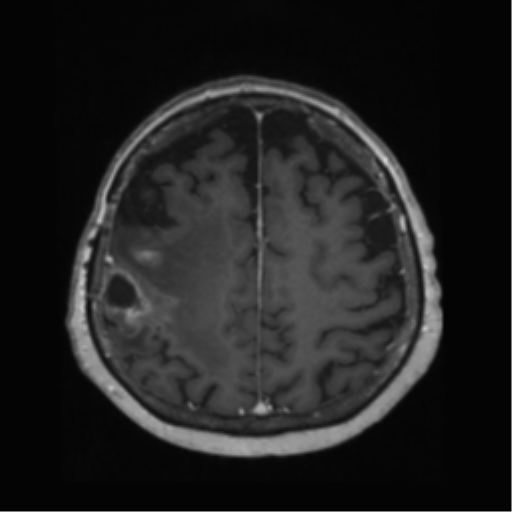 File:Anaplastic astrocytoma IDH wild-type (pseudoprogression) (Radiopaedia 42209-45278 Axial T1 C+ 114).png