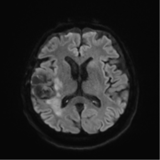 File:Anaplastic astrocytoma IDH wild-type (pseudoprogression) (Radiopaedia 42209-45279 Axial DWI 42).png
